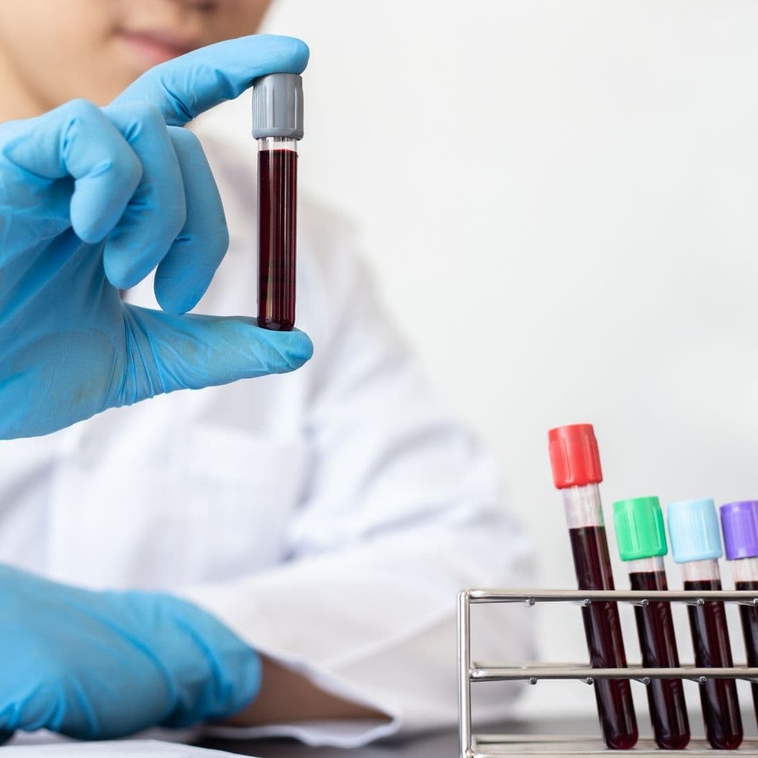 Lab Tests for PCOS