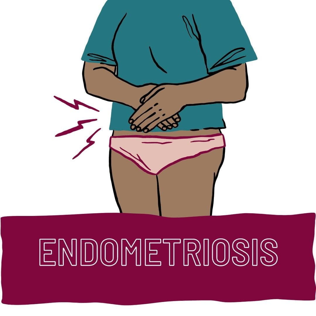 What is endometriosis?