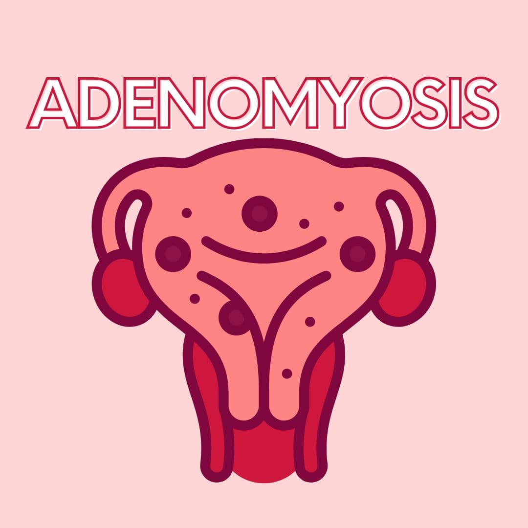 Spotting, Heavy Flow, and Period Pain: Could it be Adenomyosis?