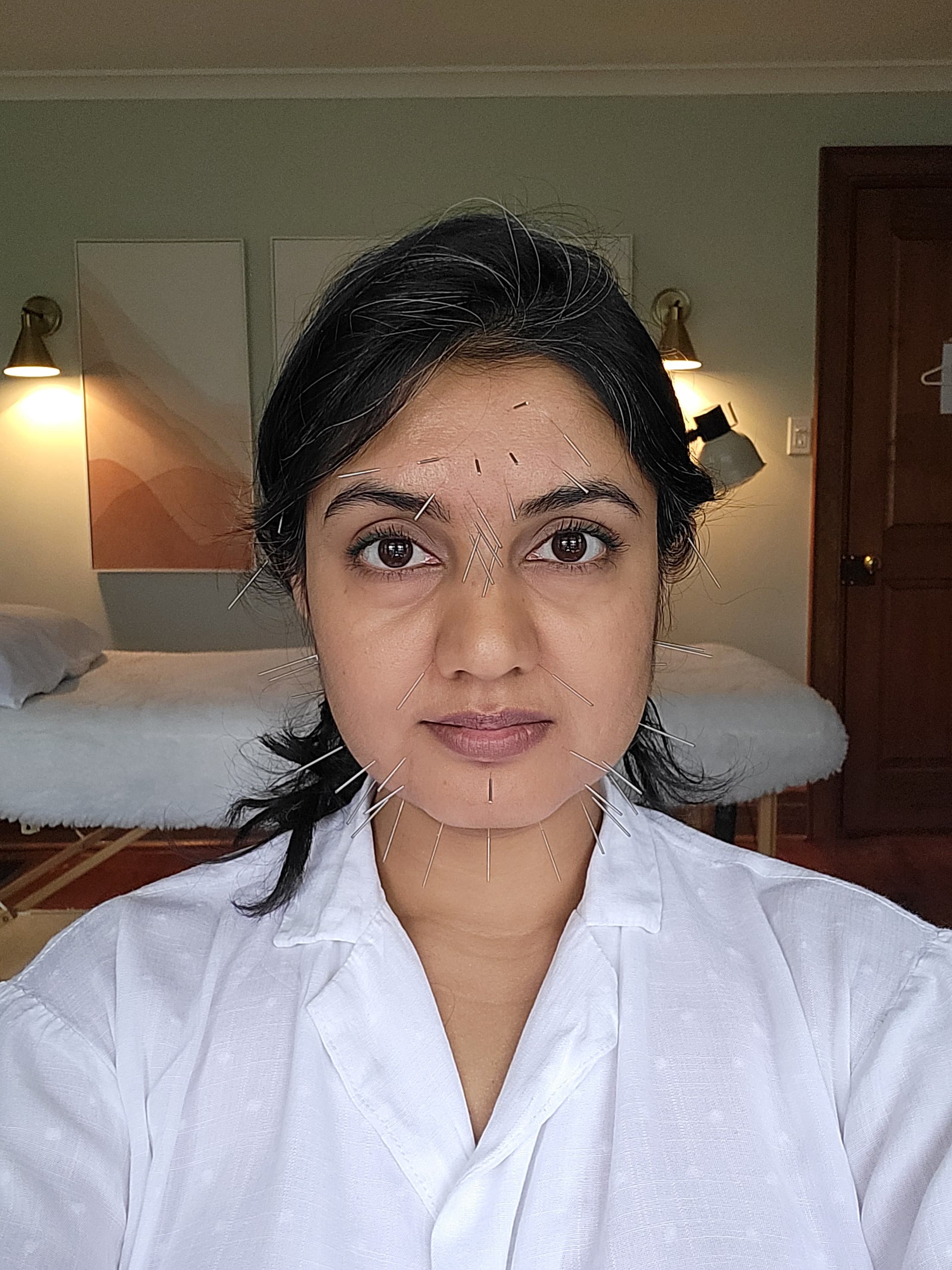 Facial Acupuncture for Your TMJ and Headaches (That Happens to Benefit Your Skin Too!)