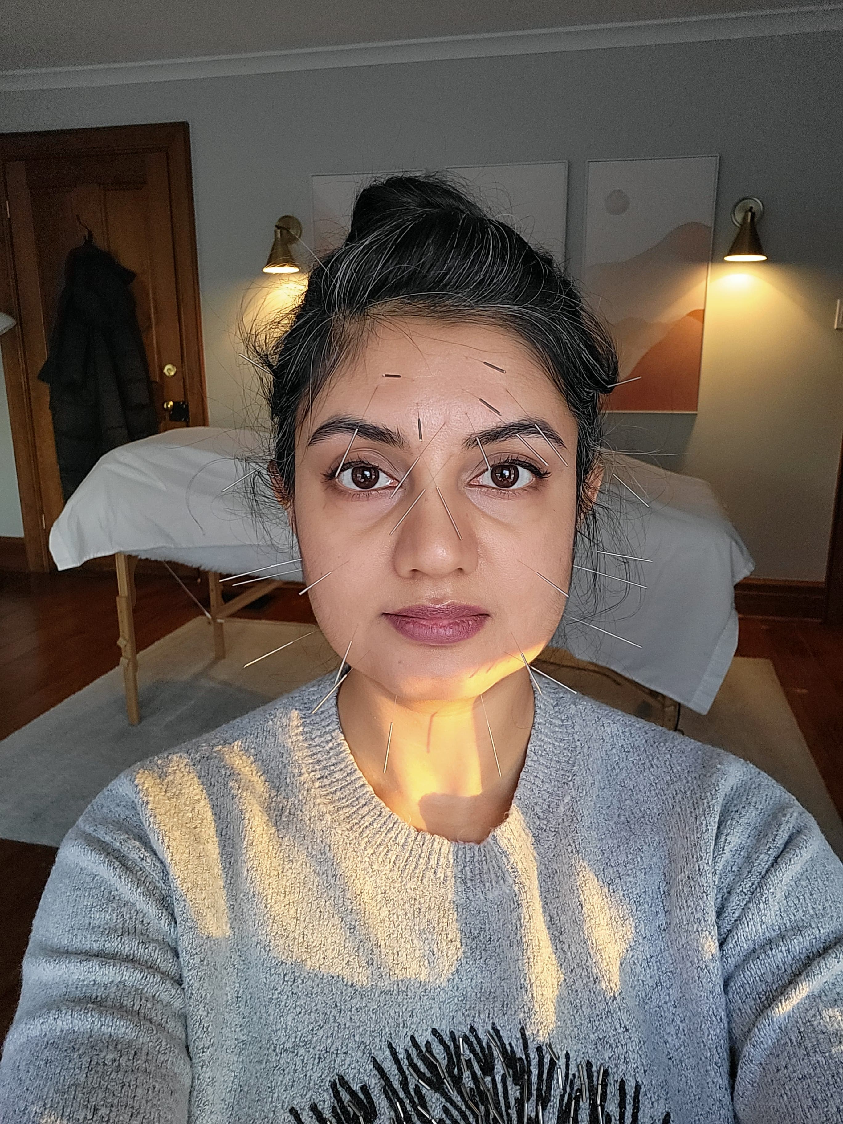 Facial Acupuncture for Your TMJ and Headaches (That Happens to Benefit Your Skin Too!)